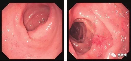 萎縮性胃炎不可怕，只要真正了解它