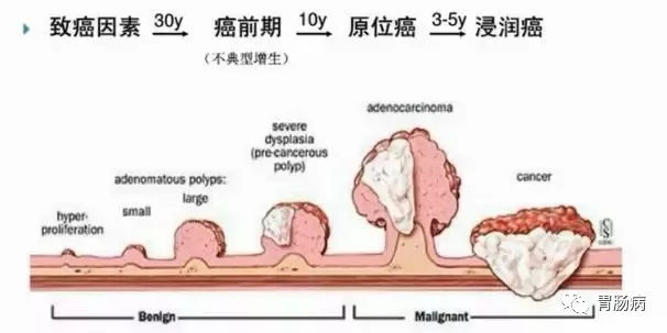 體檢查出腸息肉一定要切除！ 95%腸癌由它演變而來(lái)