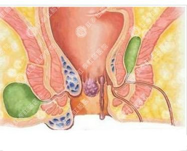 南寧哪個(gè)醫(yī)院可以做肛周膿腫？
